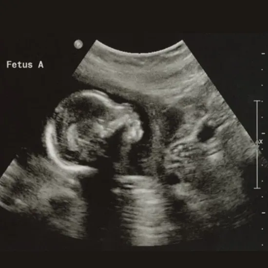 Ultrasound Level-II-Twins